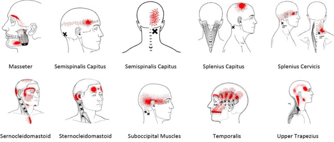 BRUXISM, HEADACHE & CERVICAL PAIN: Discovering the Hidden Connections ...